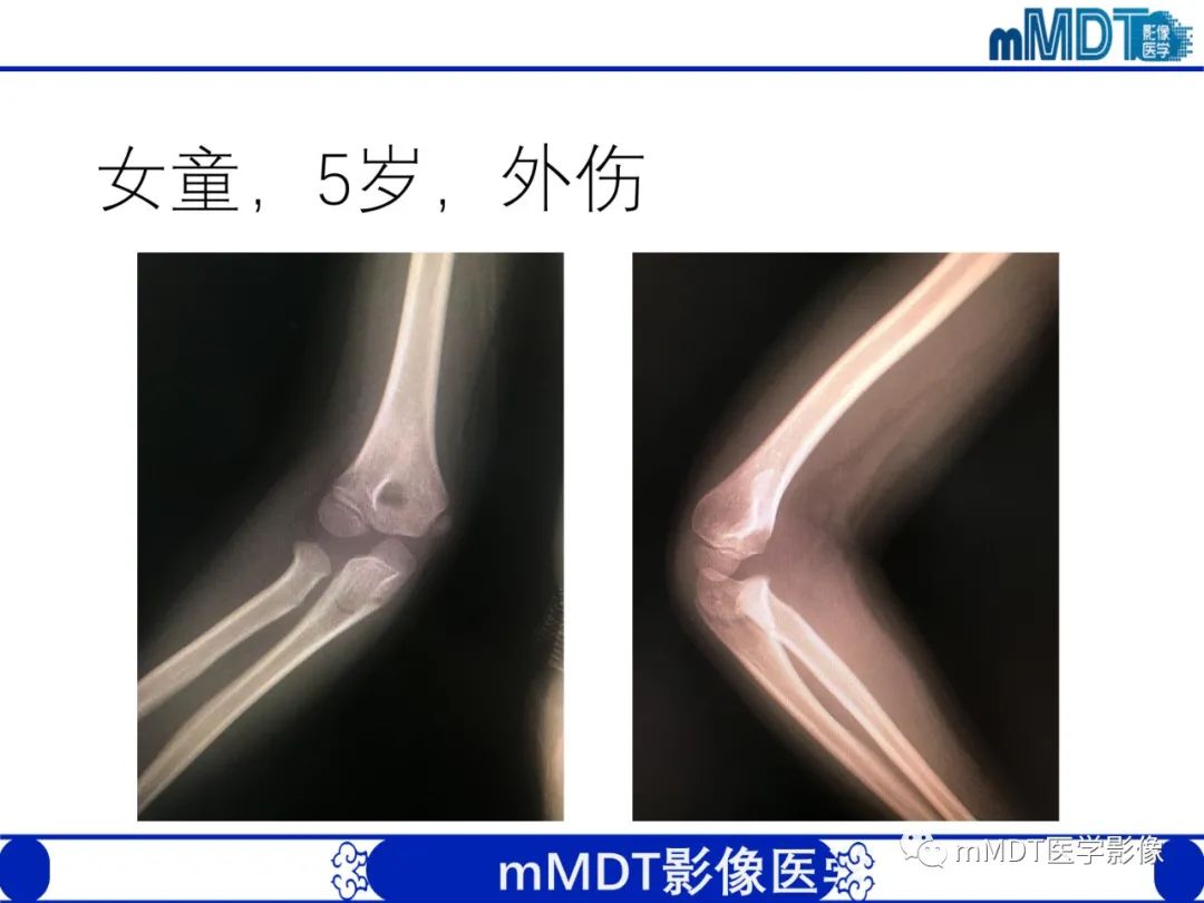 影像PPT - 【PPT】儿童肘关节损伤影像-47