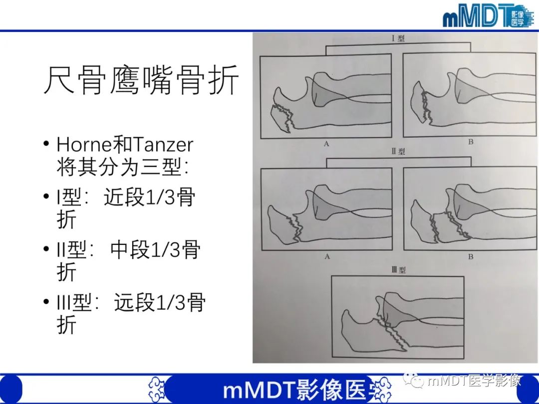 影像PPT - 【PPT】儿童肘关节损伤影像-46