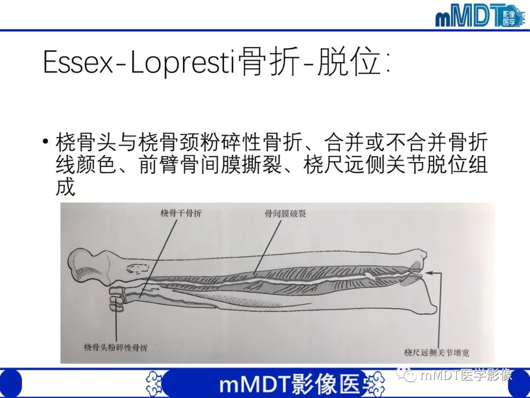 影像PPT - 【PPT】儿童肘关节损伤影像-45