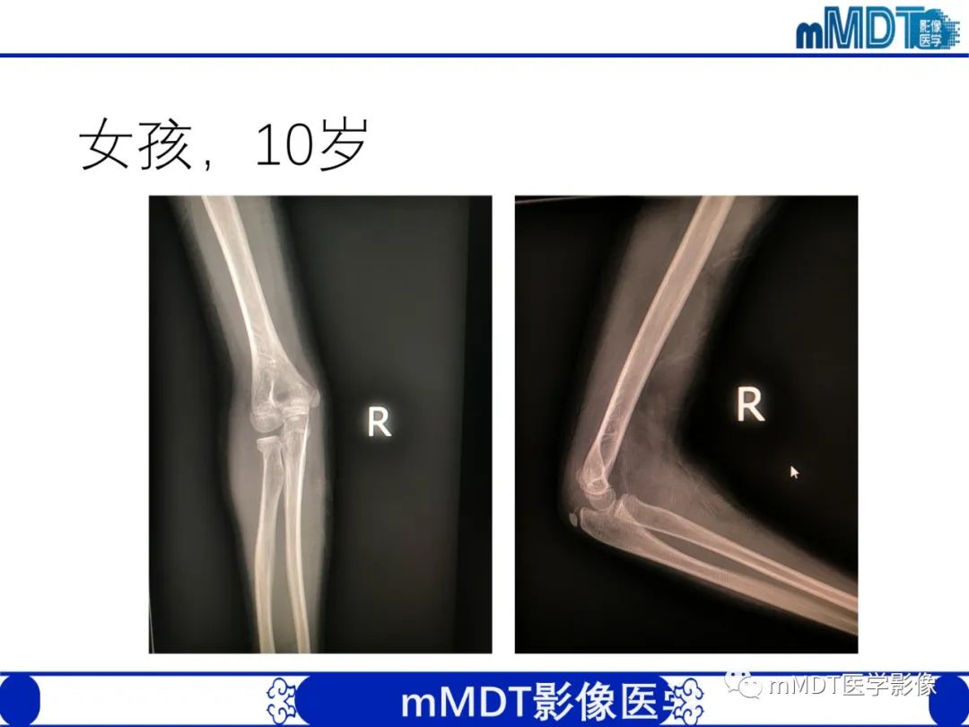 影像PPT - 【PPT】儿童肘关节损伤影像-48