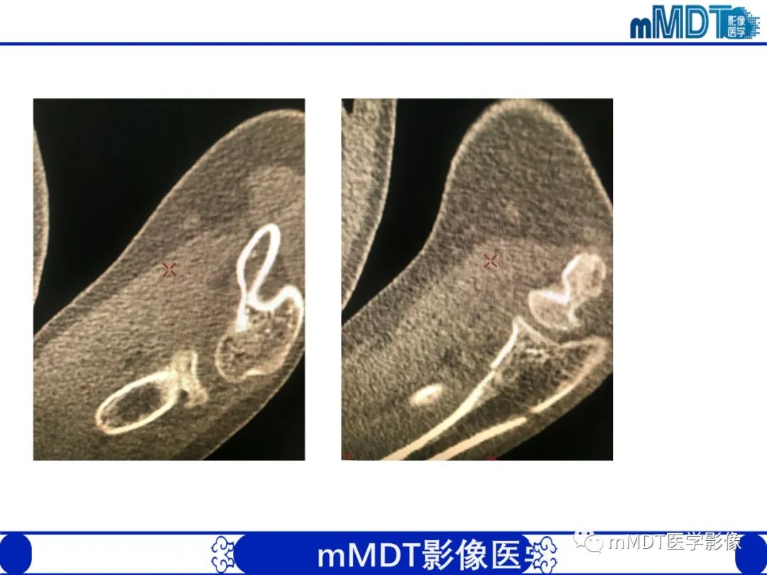 影像PPT - 【PPT】儿童肘关节损伤影像-49
