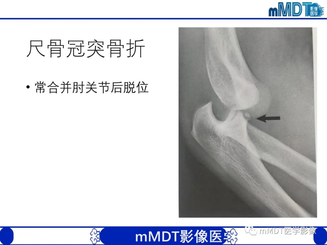 影像PPT - 【PPT】儿童肘关节损伤影像-50