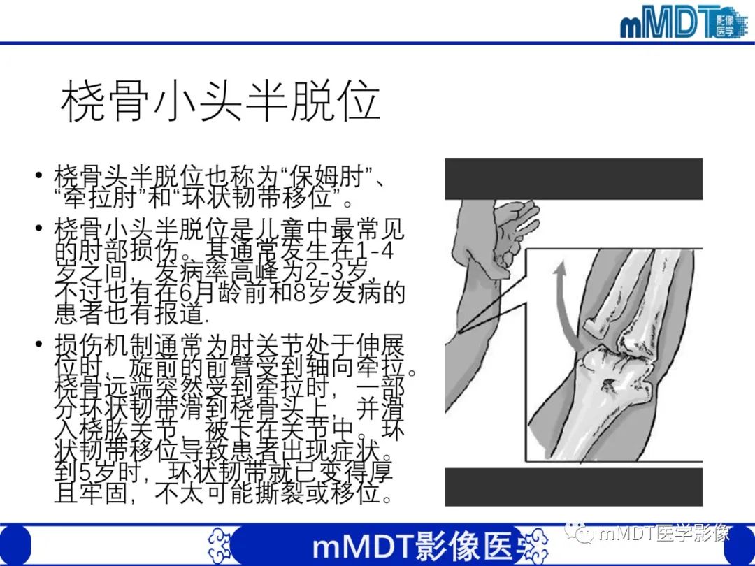 影像PPT - 【PPT】儿童肘关节损伤影像-51