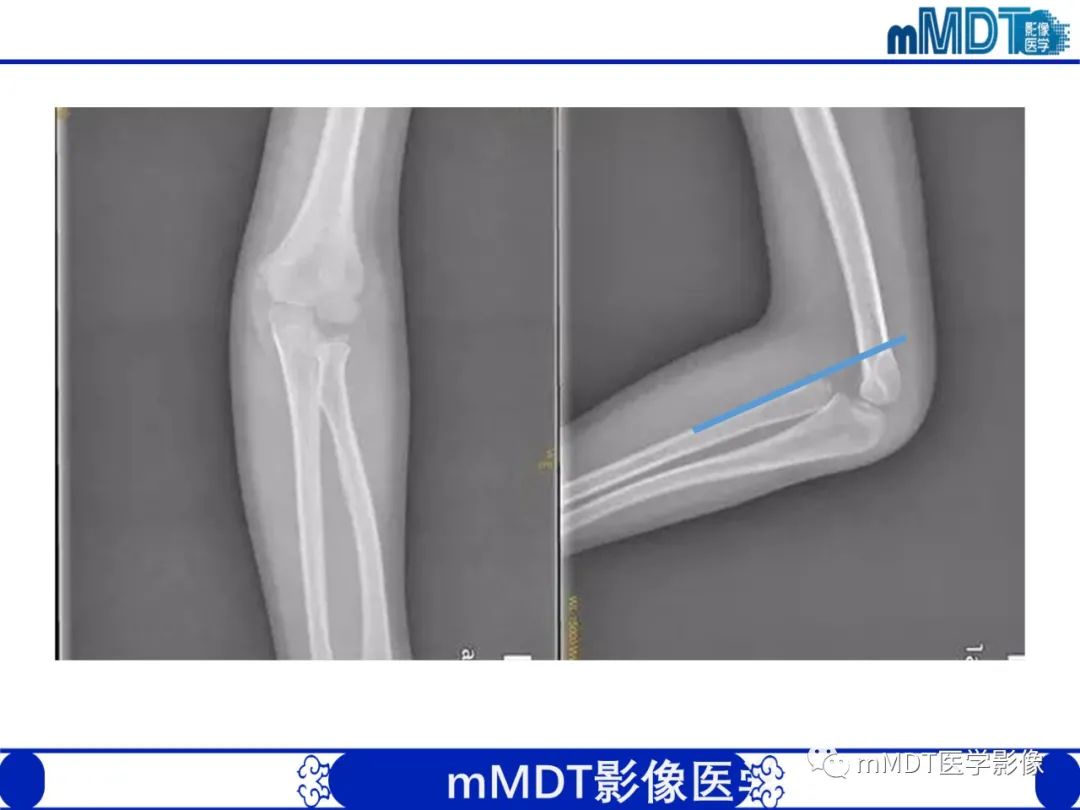 影像PPT - 【PPT】儿童肘关节损伤影像-53
