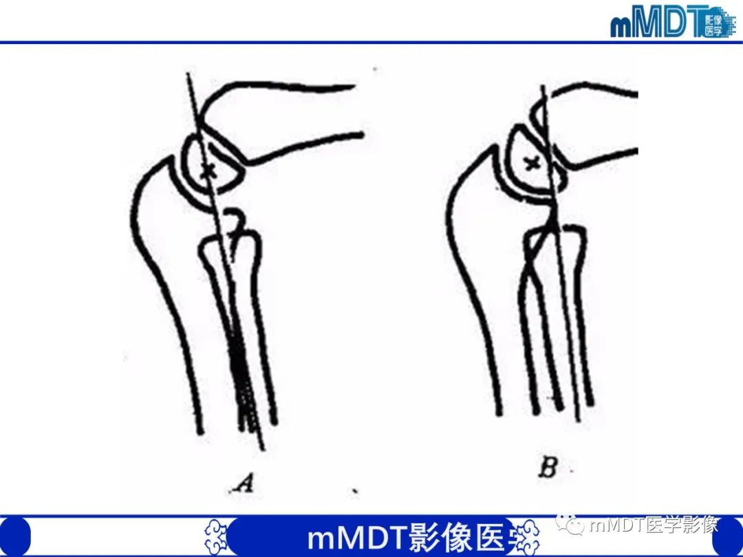 影像PPT - 【PPT】儿童肘关节损伤影像-52