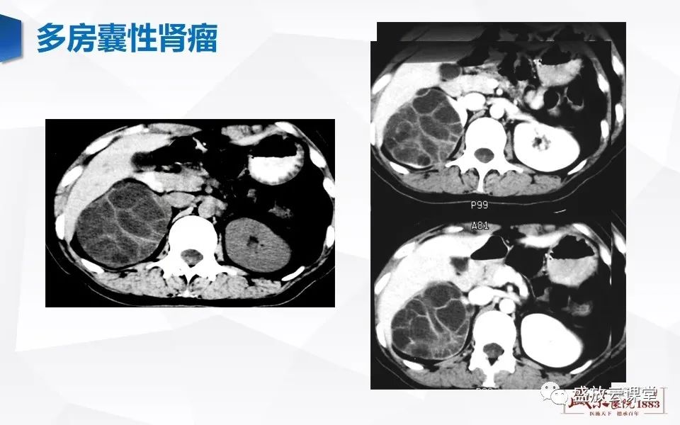 影像PPT - 【PPT】肾脏肿瘤影像诊断思辨（一）-7