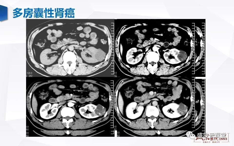 影像PPT - 【PPT】肾脏肿瘤影像诊断思辨（一）-8