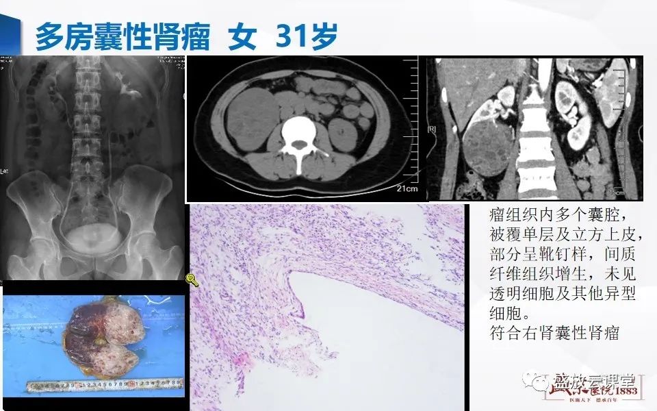 影像PPT - 【PPT】肾脏肿瘤影像诊断思辨（一）-9