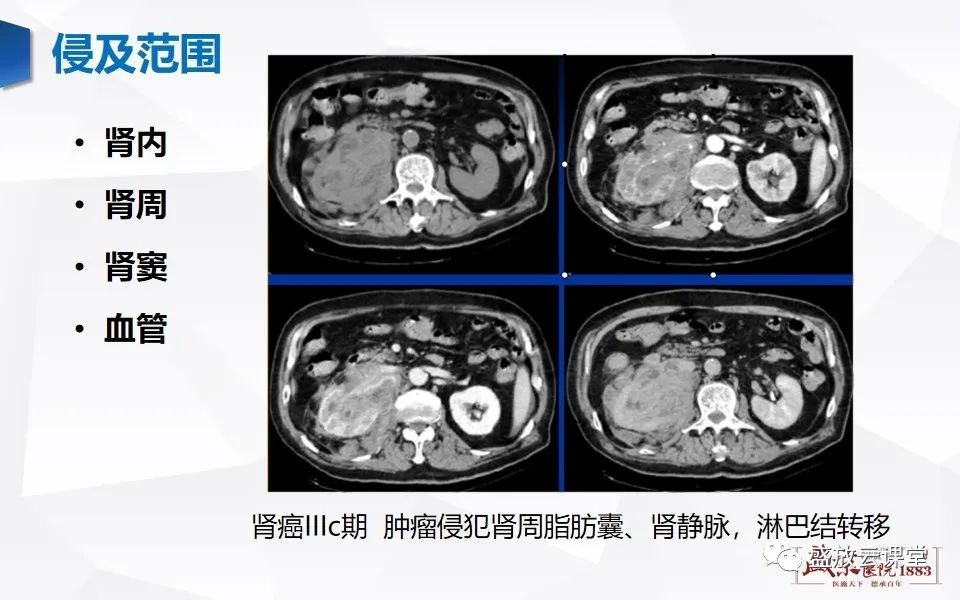 影像PPT - 【PPT】肾脏肿瘤影像诊断思辨（一）-16