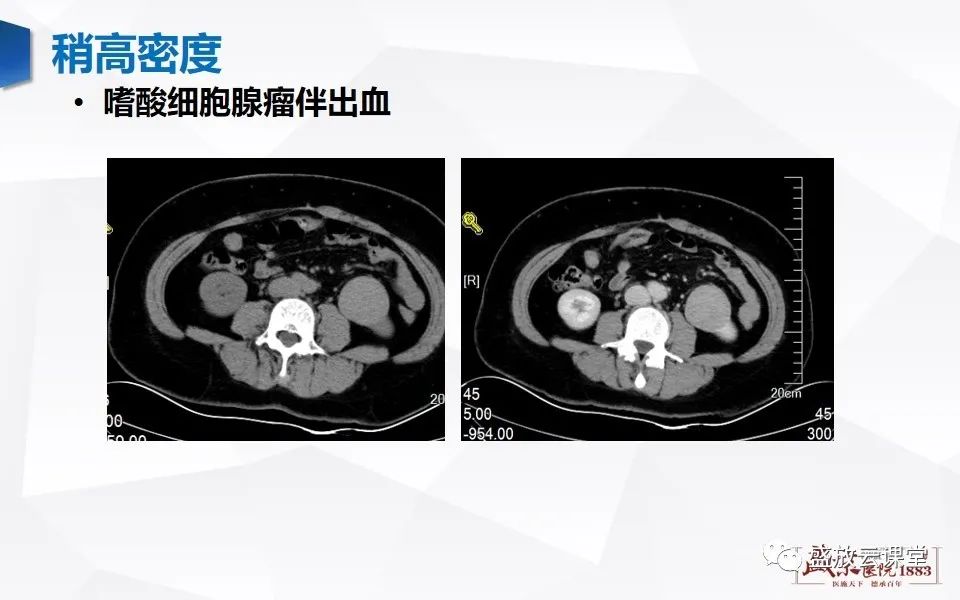 影像PPT - 【PPT】肾脏肿瘤影像诊断思辨（一）-26