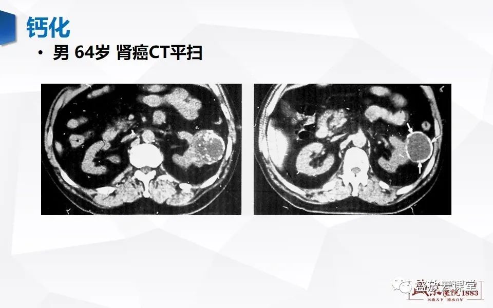影像PPT - 【PPT】肾脏肿瘤影像诊断思辨（一）-27