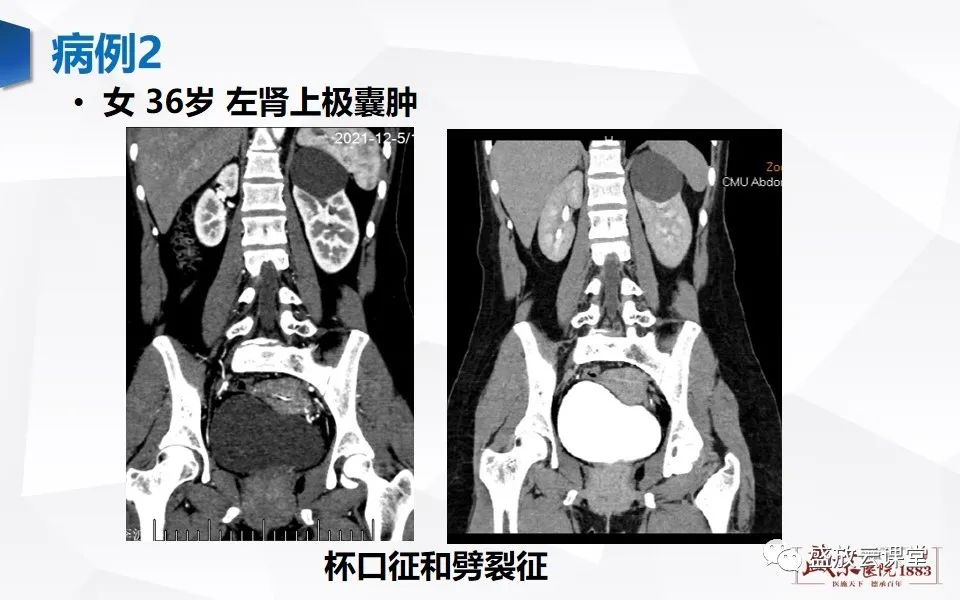影像PPT - 【PPT】肾脏肿瘤影像诊断思辨（一）-37