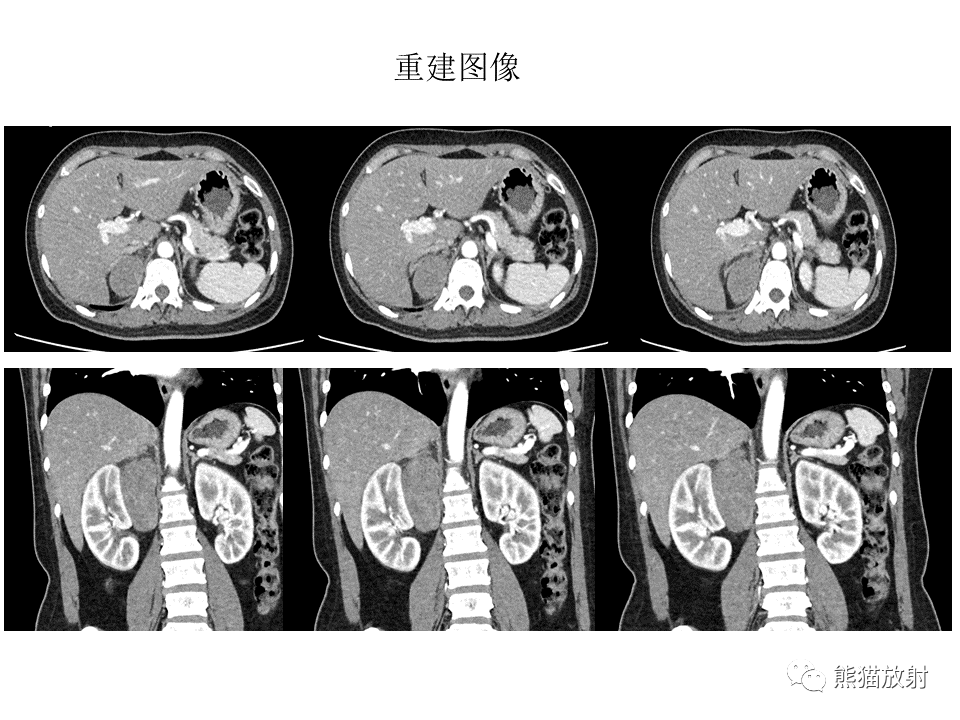 影像PPT - 【病例】副神经节瘤 VS 平滑肌肉瘤-8