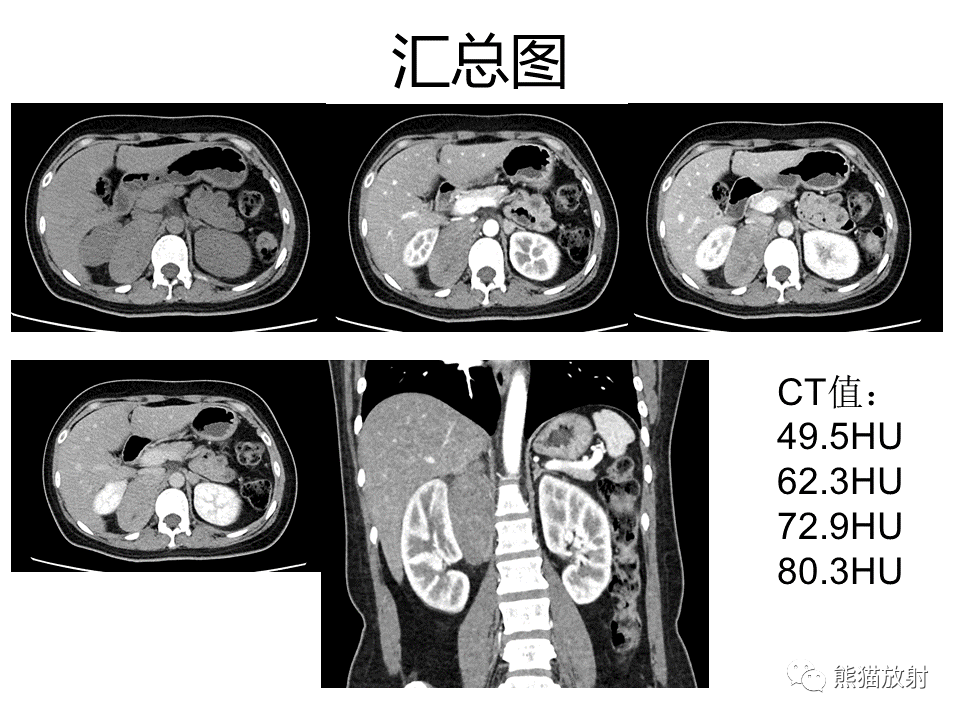 影像PPT - 【病例】副神经节瘤 VS 平滑肌肉瘤-9