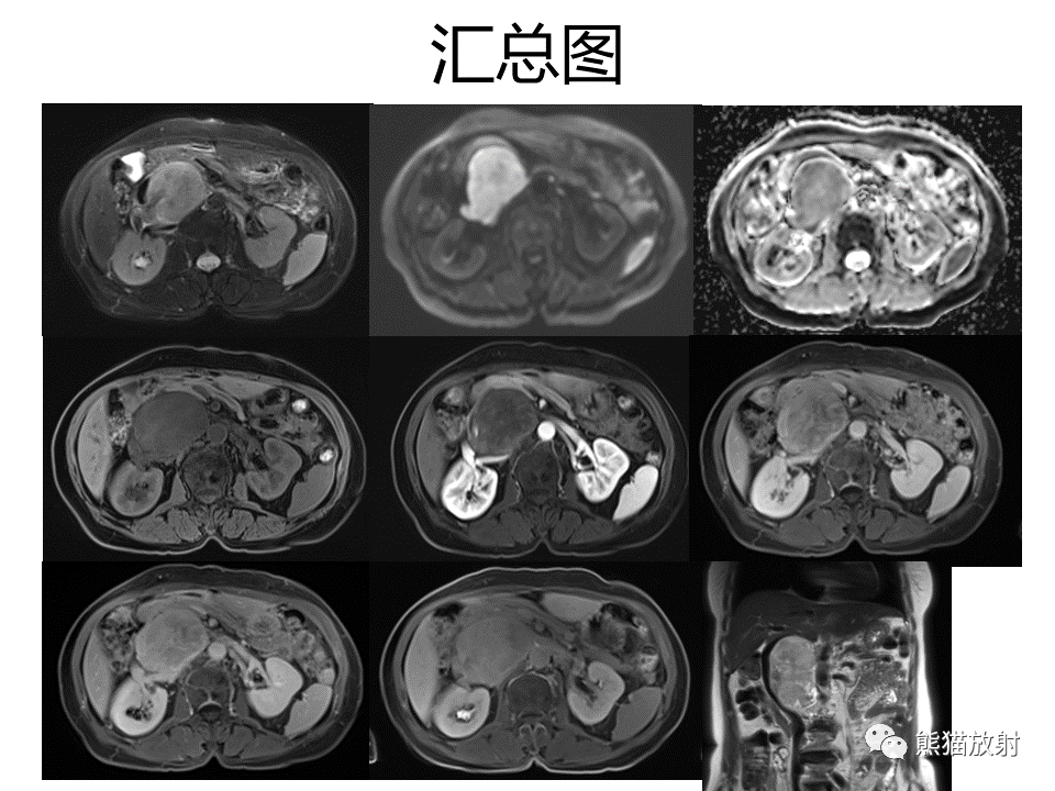 影像PPT - 【病例】副神经节瘤 VS 平滑肌肉瘤-22