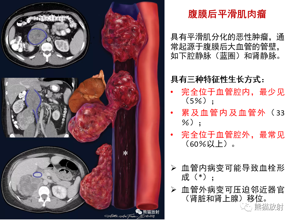 影像PPT - 【病例】副神经节瘤 VS 平滑肌肉瘤-37