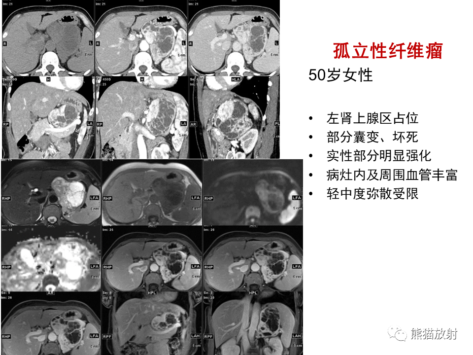 影像PPT - 【病例】副神经节瘤 VS 平滑肌肉瘤-39