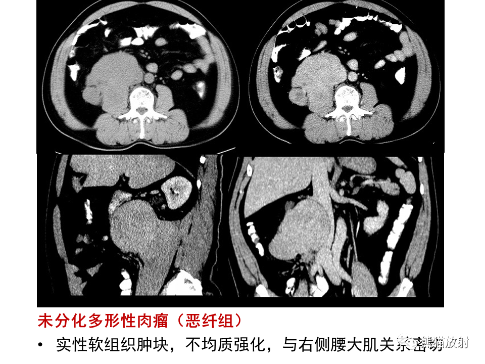 影像PPT - 【病例】副神经节瘤 VS 平滑肌肉瘤-47