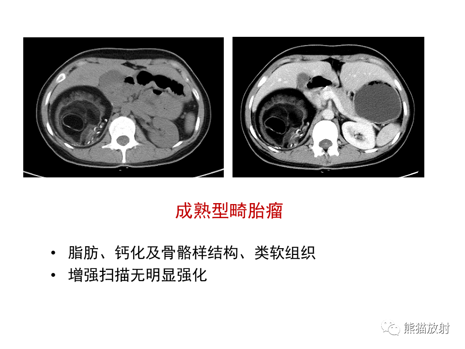 影像PPT - 【病例】副神经节瘤 VS 平滑肌肉瘤-50