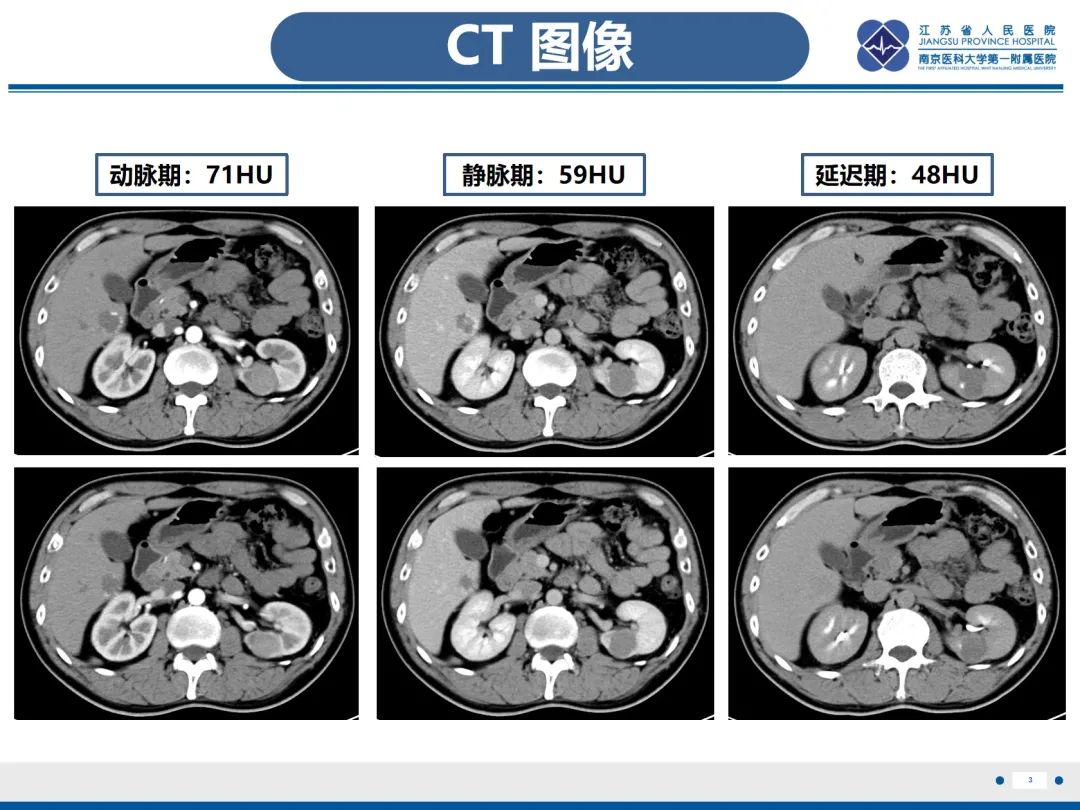 影像PPT - 【PPT】肾嫌色细胞癌-4