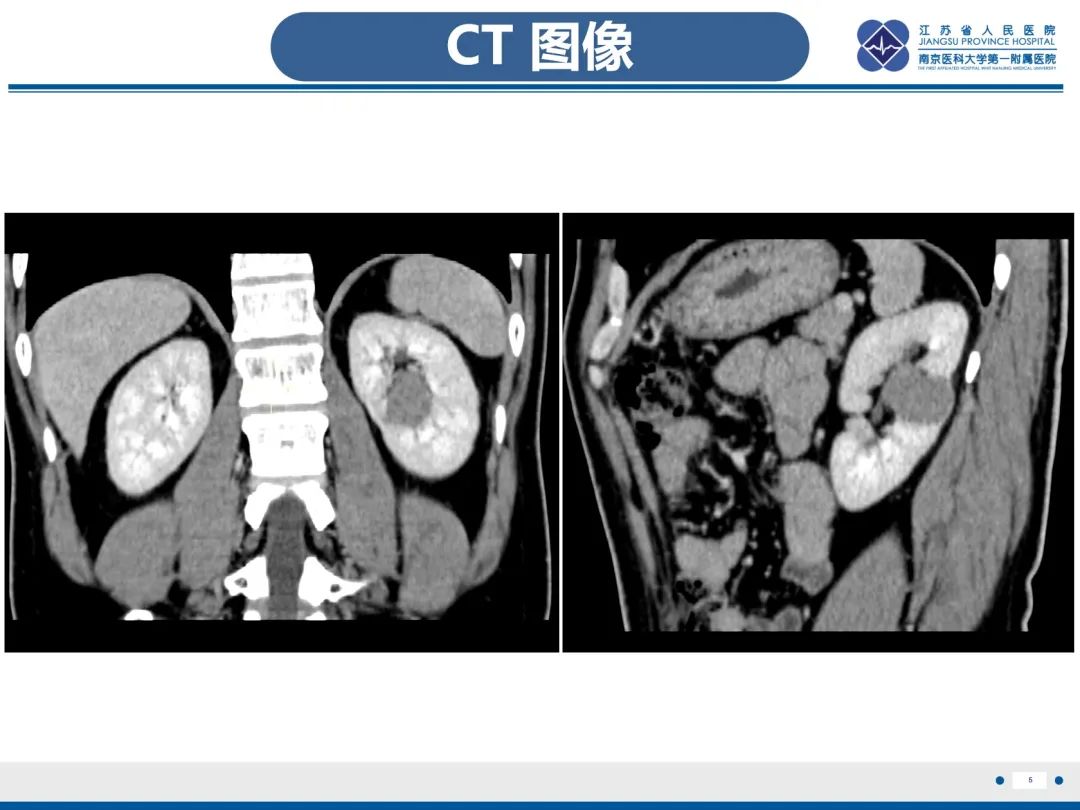 影像PPT - 【PPT】肾嫌色细胞癌-6
