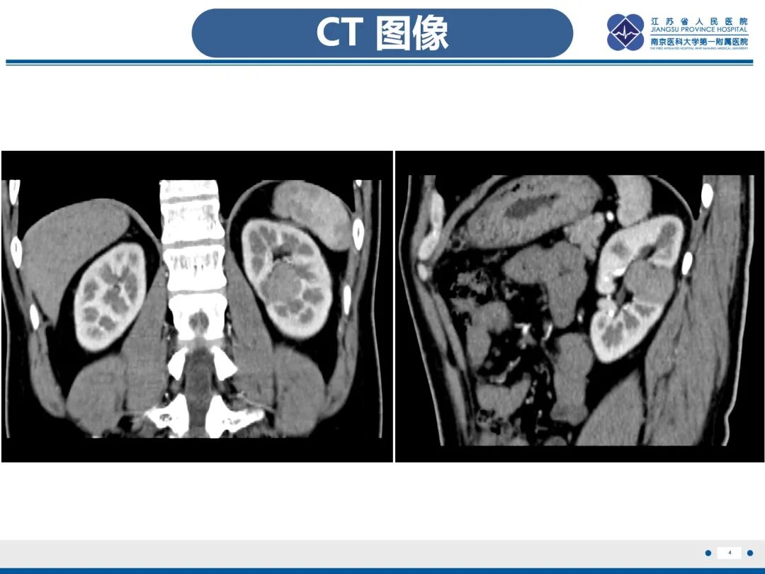 影像PPT - 【PPT】肾嫌色细胞癌-5