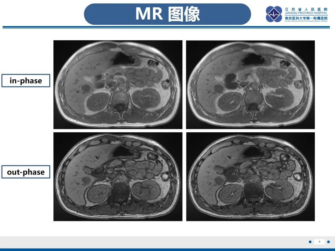 影像PPT - 【PPT】肾嫌色细胞癌-7