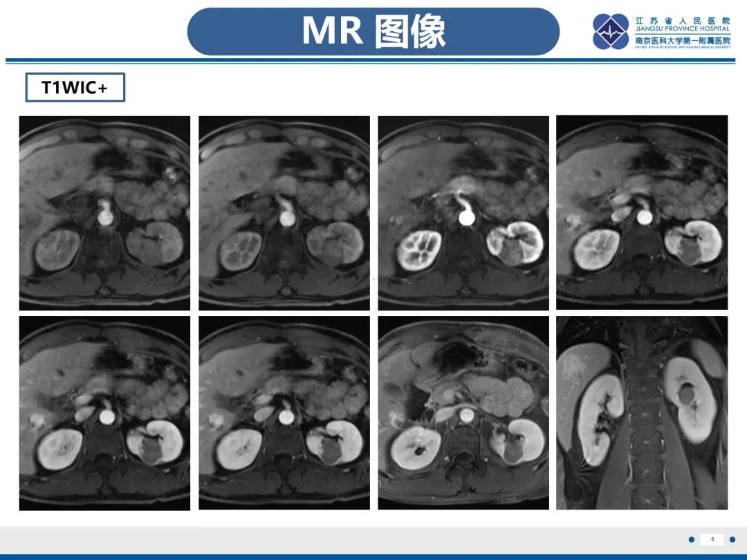 影像PPT - 【PPT】肾嫌色细胞癌-9