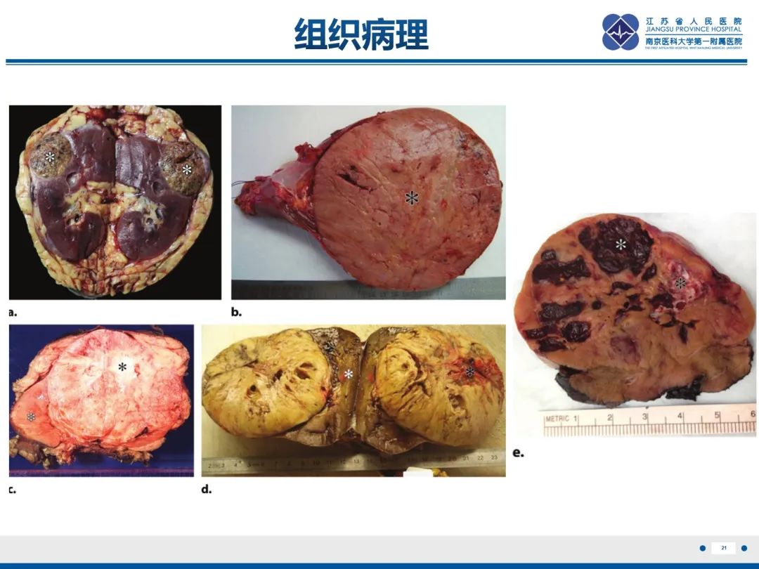 影像PPT - 【PPT】肾嫌色细胞癌-22