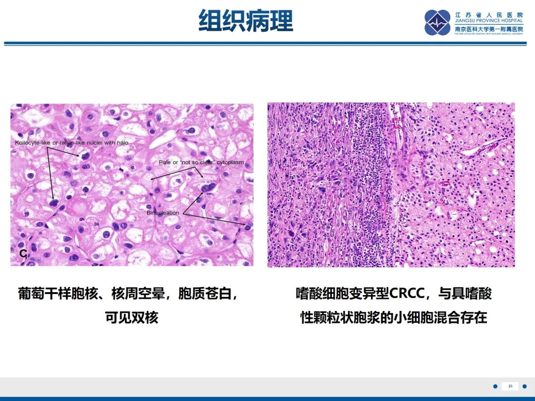 影像PPT - 【PPT】肾嫌色细胞癌-24