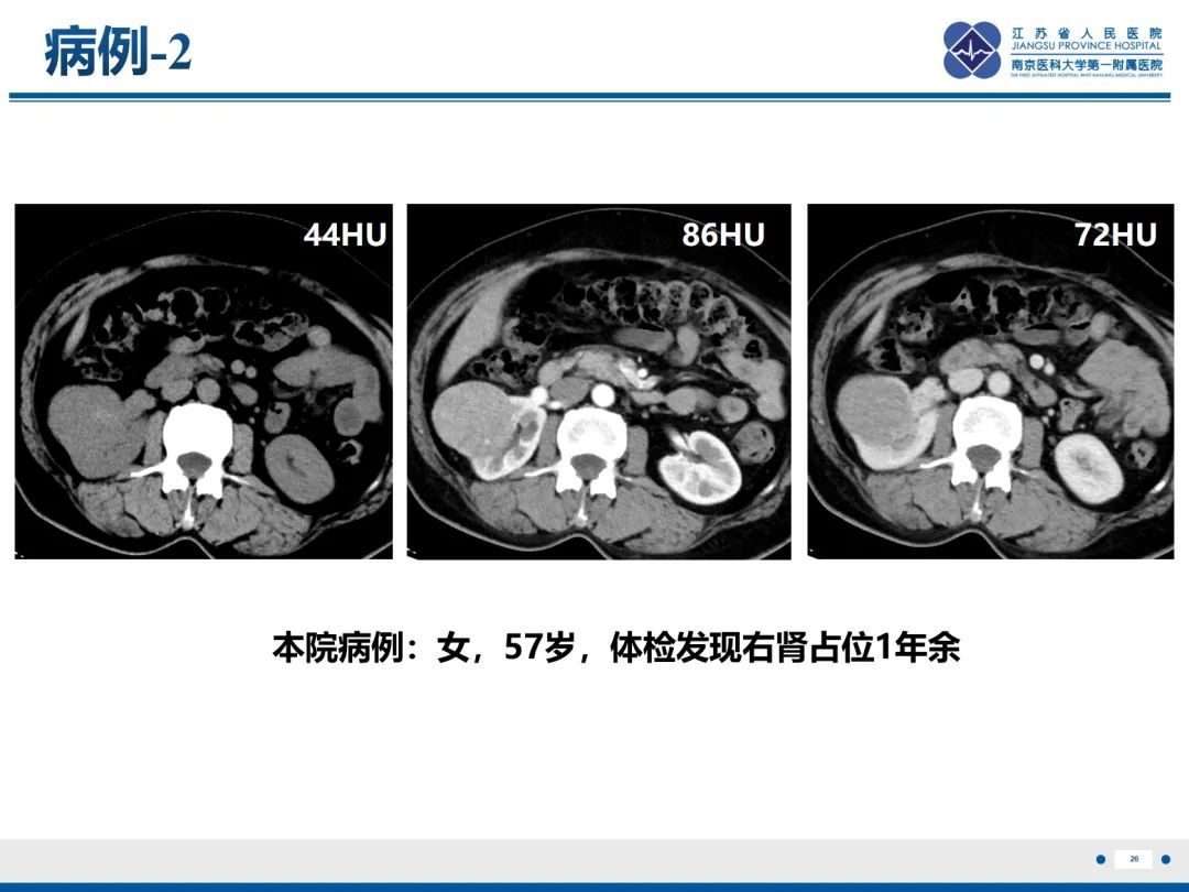 影像PPT - 【PPT】肾嫌色细胞癌-27