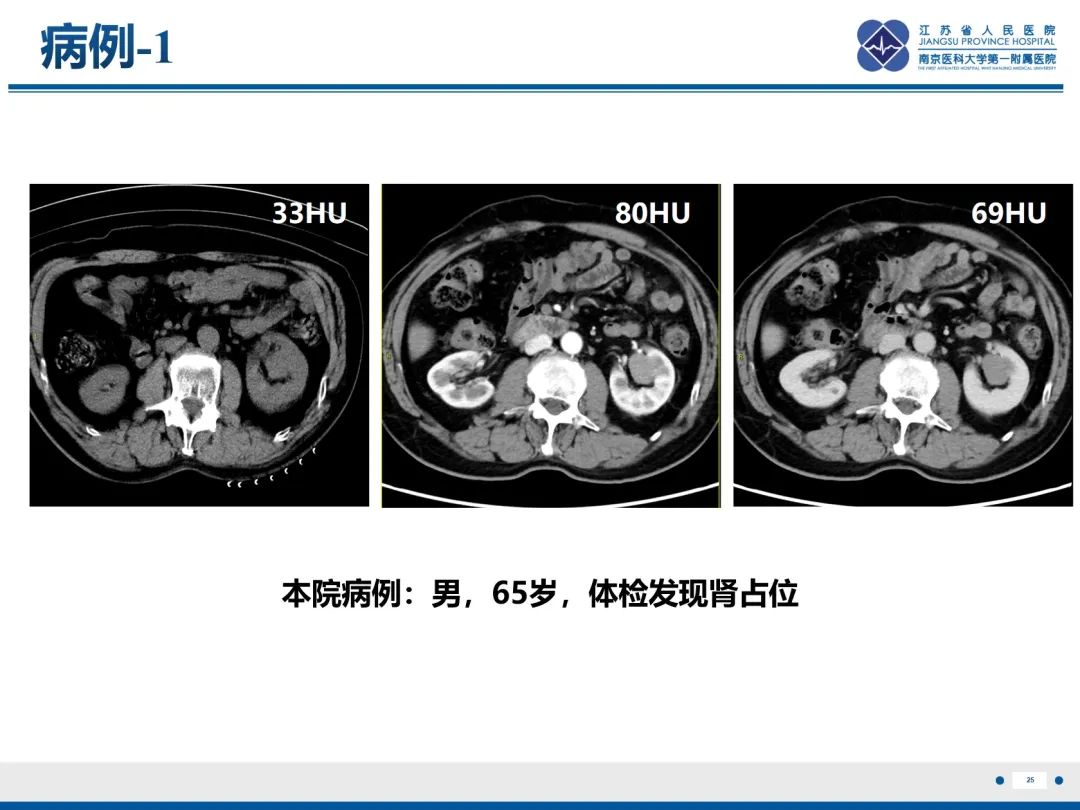 影像PPT - 【PPT】肾嫌色细胞癌-26