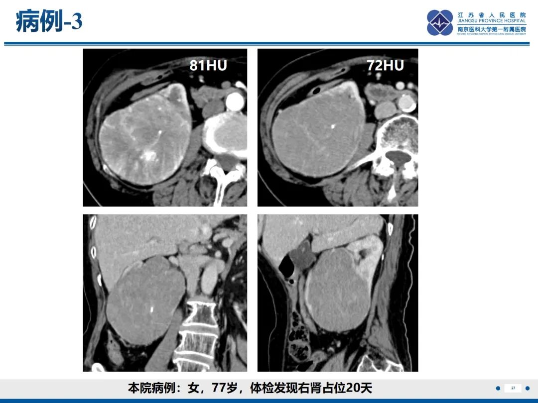影像PPT - 【PPT】肾嫌色细胞癌-28
