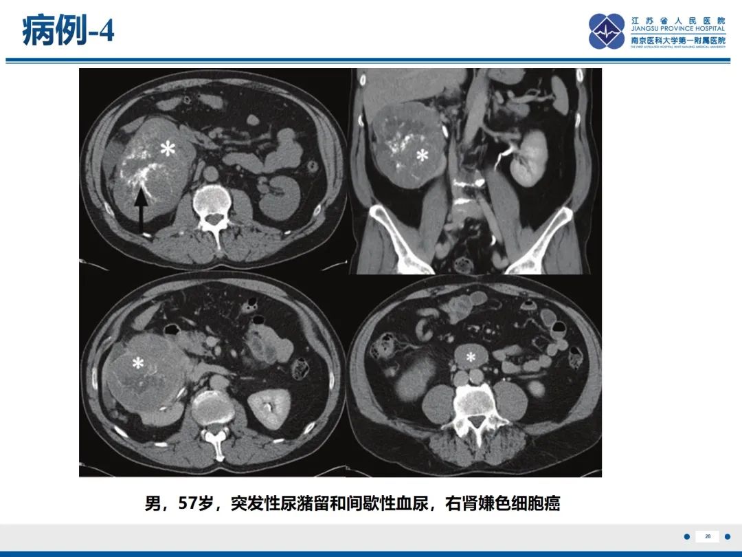 影像PPT - 【PPT】肾嫌色细胞癌-29