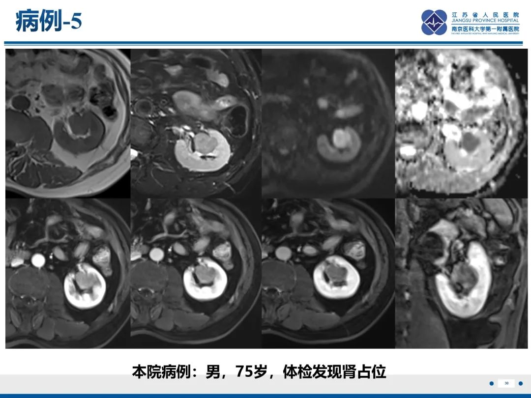 影像PPT - 【PPT】肾嫌色细胞癌-31