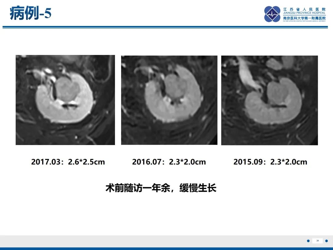 影像PPT - 【PPT】肾嫌色细胞癌-32