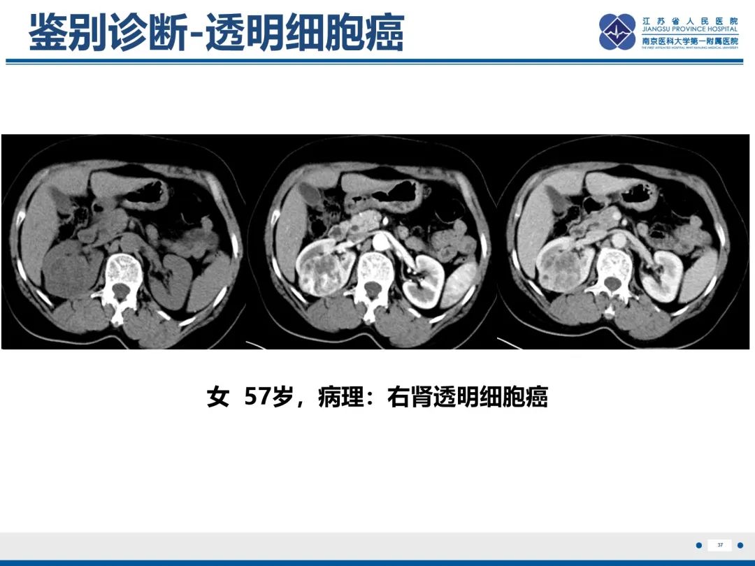 影像PPT - 【PPT】肾嫌色细胞癌-38
