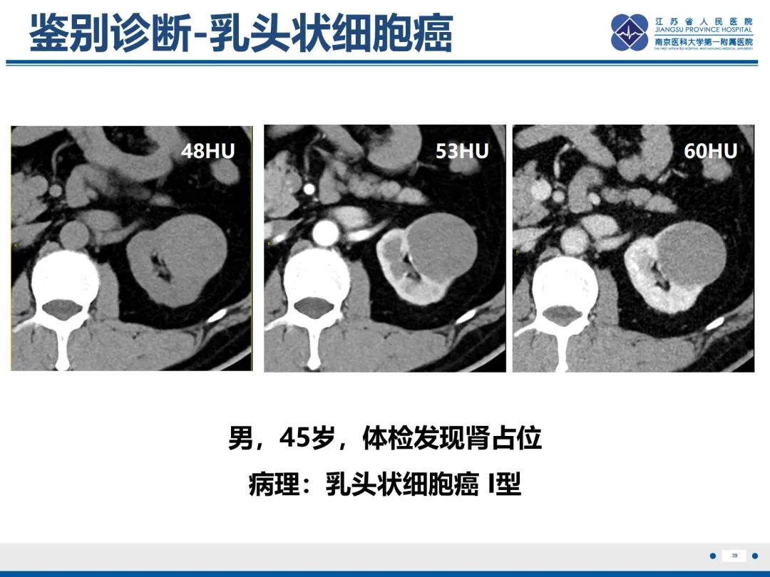 影像PPT - 【PPT】肾嫌色细胞癌-40