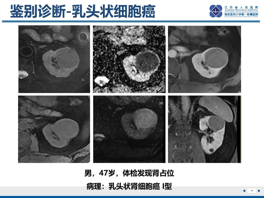 影像PPT - 【PPT】肾嫌色细胞癌-41