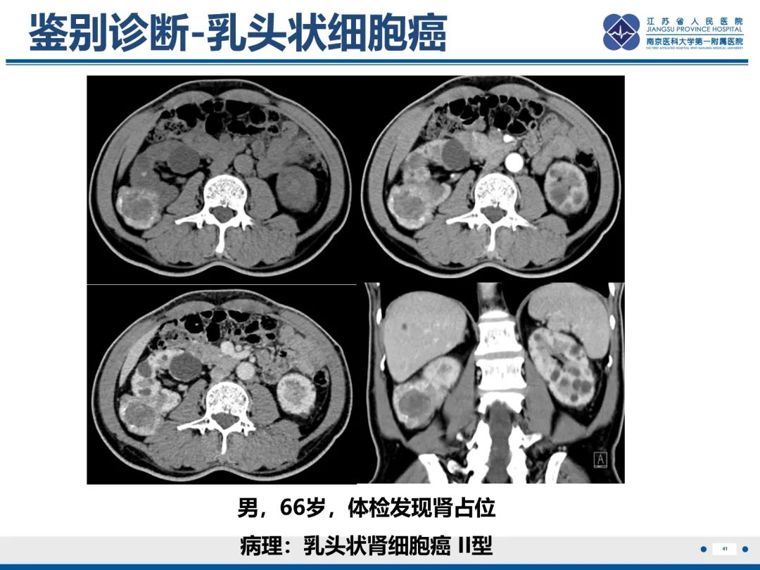 影像PPT - 【PPT】肾嫌色细胞癌-42