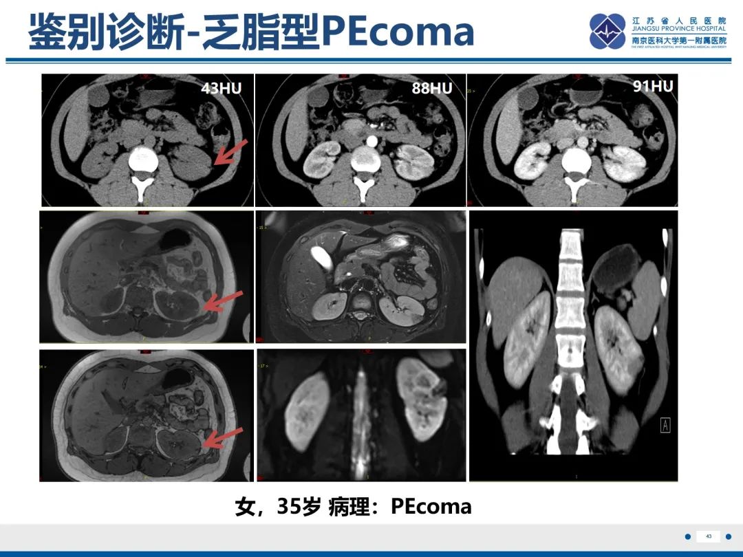 影像PPT - 【PPT】肾嫌色细胞癌-44