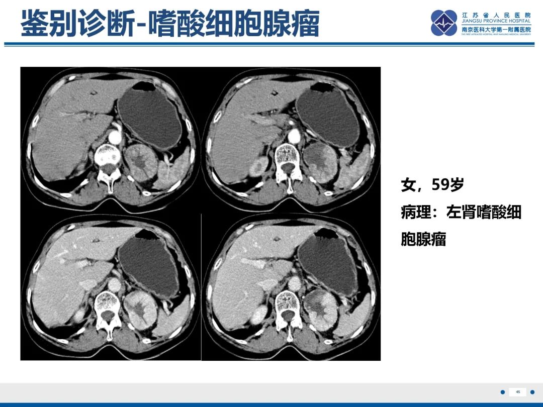 影像PPT - 【PPT】肾嫌色细胞癌-46