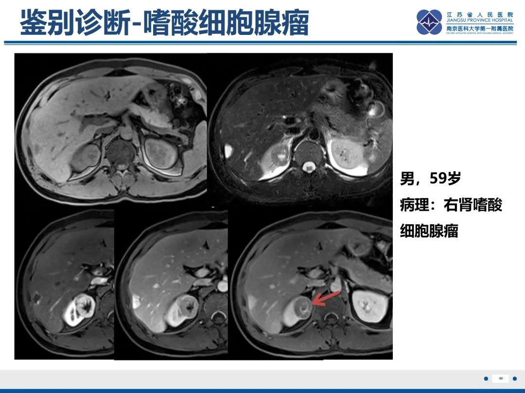 影像PPT - 【PPT】肾嫌色细胞癌-47