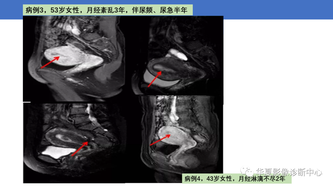 影像PPT - 【PPT】子宫内膜疾病的MRI诊断及鉴别-3