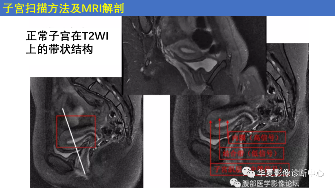 影像PPT - 【PPT】子宫内膜疾病的MRI诊断及鉴别-6