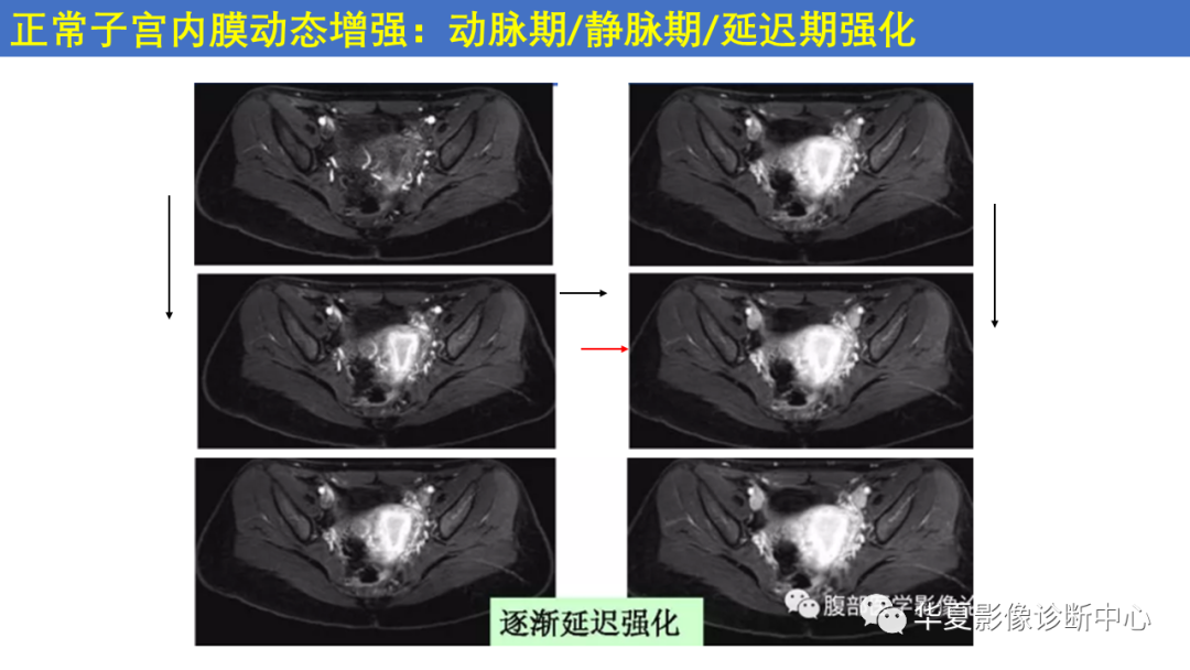 影像PPT - 【PPT】子宫内膜疾病的MRI诊断及鉴别-10