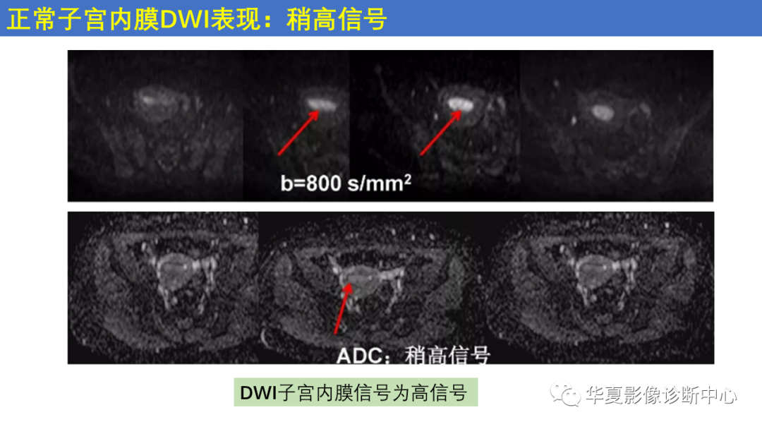 影像PPT - 【PPT】子宫内膜疾病的MRI诊断及鉴别-11