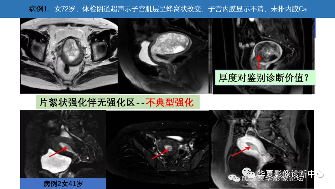 影像PPT - 【PPT】子宫内膜疾病的MRI诊断及鉴别-2