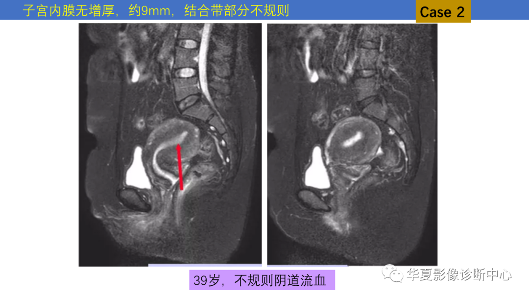 影像PPT - 【PPT】子宫内膜疾病的MRI诊断及鉴别-13