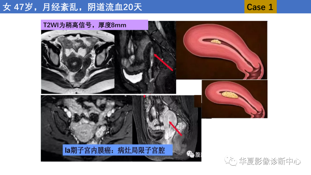 影像PPT - 【PPT】子宫内膜疾病的MRI诊断及鉴别-12